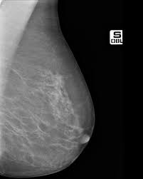 mammografia